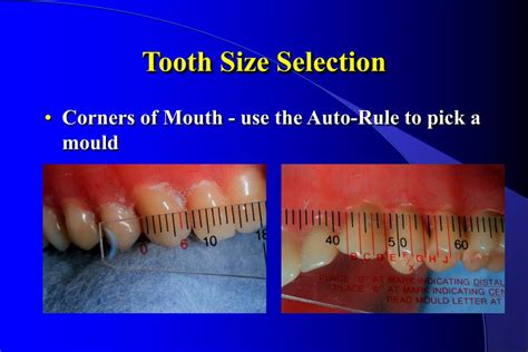 methods to measure tooth thickness|how to measure tooth size.